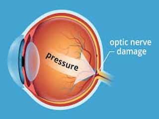 Glaucoma Eye diagram