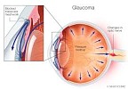 glaucoma WA diagrame